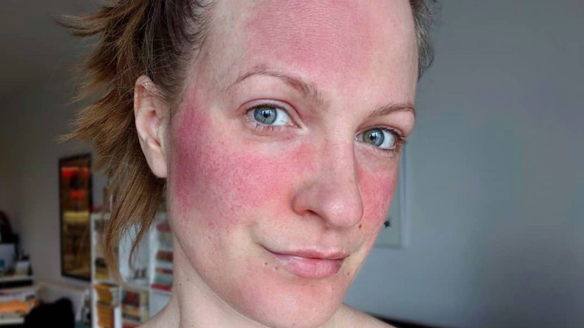 How to Soothe Rosacea with the Best Moisturisers in Australia