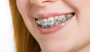 Orthodontics in Noida at Floss Dental Clinic